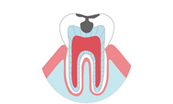 広島県呉市阿賀中央・小早川歯科医院・むし歯