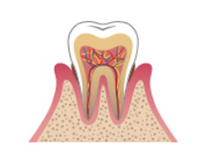 広島県呉市阿賀中央・小早川歯科医院・歯周病
