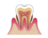 広島県呉市阿賀中央・小早川歯科医院・歯周病